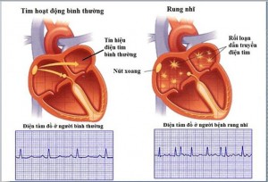 Để trái tim không “run rẩy”